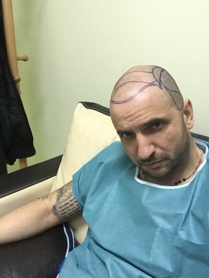 Цецо преди процедурата